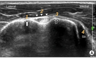 Shoulder question 37 reference image with original annotations.