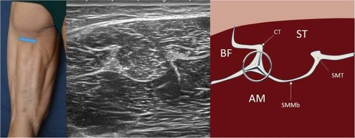 Ultrasound cross-section alongside probe placement and a labeled anatomical illustration